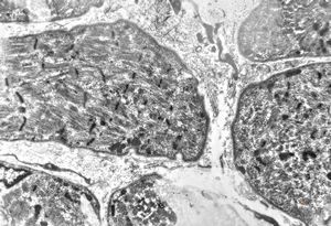 M,2m. | hypotonic syndrome - muscular atrophy M,2m. | hypotonic syndrome - muscular atrophy
